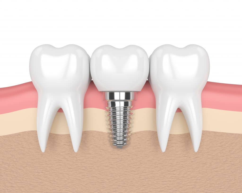 Dental Implants graphic