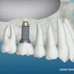 Graft Material and Implant Placed graphic