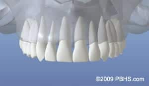 Dental Implant graphic