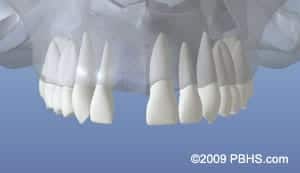 Dental Implant graphic