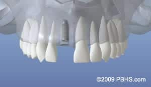 Dental Implant graphic