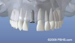 Dental Implant graphic