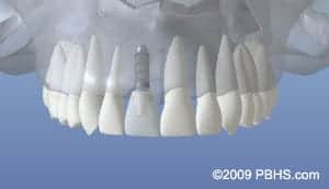 Dental Implant graphic