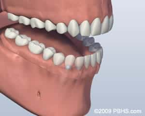 Denture Attached graphic