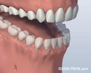 Denture Attached graphic