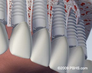 Upper Implants graphic